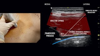 Paravertebral Block  UltrasoundGuided Demonstration [upl. by Corrine]