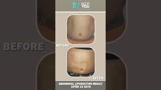 Abdominal Liposuction Procedure and Results after 15 days  Before and After Results  Dr PK Talwar [upl. by Shaefer]