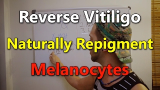 VITILIGO Increase Natural Pigmentation  Reverse Vitiligo amp Increase alphaMSH [upl. by Rai]