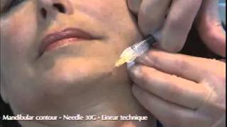 Viscoderm 16 30 Gneedle Dr Salti [upl. by Runkle]