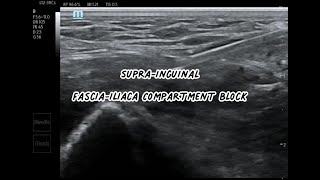 Supra Inguinal FasciaIliaca Block SIFI Block [upl. by Casilda]