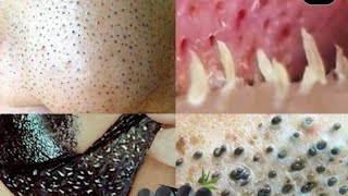 Isto Elimina ESPINHAS Inflamadas e Tira Cravo No Nariz em 1 Noite😱😱😱 [upl. by Assiran]