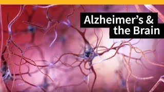 How Alzheimers Changes the Brain [upl. by Shyamal]