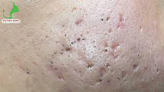 Satisfying SkinCare Blackheads Acne Extraction Video With Dr Thuy QGSPA Date Nov122024 1 [upl. by Schiffman]