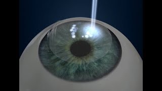 Vision Correction by Laser and Refractive Surgery [upl. by Iel602]