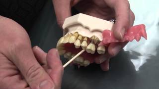 What is Periodontal Disease [upl. by Eenot]