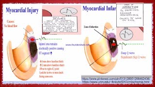 ST segment changes in Myocardial infraction [upl. by Davilman969]