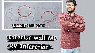 Mastering ECGLesson7 IWMI  RV infarct ECG discussion [upl. by Crawford]