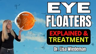 FLOATERS  What you need to know [upl. by Yaral]