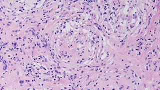 A Case of Granulomatous Orchitis  Pathology mini tutorial [upl. by Tjaden]