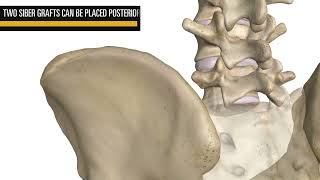 CoreLink Siber® Bone Posterior SI Allograft System [upl. by Aihcela]