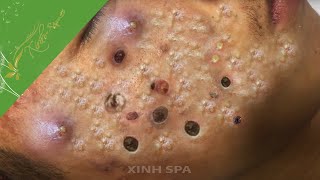 Treatment of Blackheads and Hiden Acne For Quoc come back from Colorado Part 1 [upl. by Retrak]