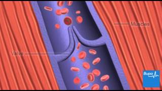 Deep Vein Thrombosis  Overview pathophysiology treatment complications [upl. by Monjan514]