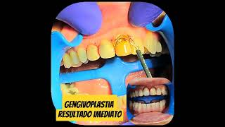 Gengivoplastia  Resultado Imediato [upl. by Hinkel330]