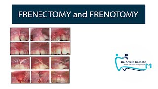 FRENECTOMY and FRENOTOMY TREATMENT OF ABERRANT FRENUM PERIODONTAL PLASTIC AND ESTHETIC SURGERY [upl. by Adnawat516]