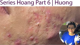 Acne Treatment Huong Da Nang 023  Series 6 Hoang Loyal fans [upl. by Dorison]