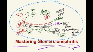 Calculative Glomerulonephritis [upl. by Sayre]