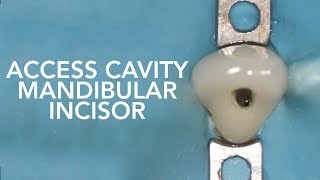 Pre Clinical Endodontic  Access Cavity of Mandibular Incisor [upl. by Arakihc870]