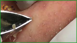 Best Satisfying Nose Plucking Blackheads Whiteheads Removal  Acne Treatment 29 [upl. by Acirej]