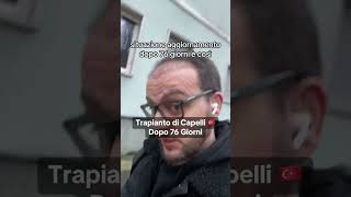 Trapianto di Capelli 🇹🇷 Dopo 76 Giorni trapianto trapiantocapelli trapiantodicapelli [upl. by Ynatsyd]