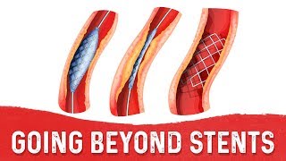 Stents May be the Patch But Whats the Fix – DrBerg [upl. by Asirehc81]