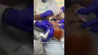 CO2 Laser  Wart Removal  Dhaka Dermatology Institute  LaserTreat [upl. by Ameg]