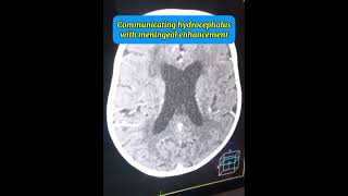 Diagnosing Communicating Hydrocephalus CT Brain Findings in TB Meningitis vs Pyogenic Meningitis [upl. by Ahseem]