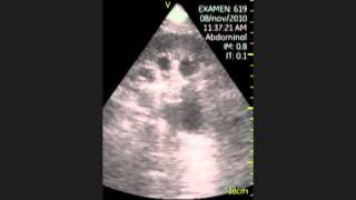 VSCAN Hydronephrosis grade III Pocket Ultrasound Hidronefrosis grado III Eco de bolsillo [upl. by Anak922]