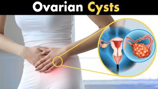 Common signs and symptoms of ovarian cysts Shorts  UHL NHS Trust [upl. by Attenaz]