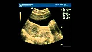 USG Guided Embryo Transfer Video [upl. by Assiar241]