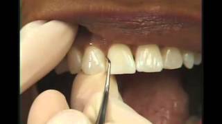 Periodoncia  Raspado [upl. by Ibmat91]