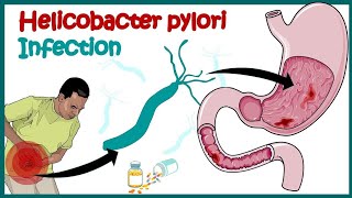 Helicobacter Pylori Infection Gastric Ulcer Causes Signs and Symptoms [upl. by Annavoeg464]