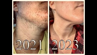 144 Hours of Electrolysis Hair Removal  Before and After Pics amp Footage  PCOS  Hirsutism Support [upl. by Danete]