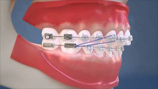 Class II Elastics  Lateral View HD Edition [upl. by Inal]