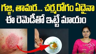 ఈ చిట్కాతో గజ్జి తామర మాయం  Best Home Remedies for Skin Allergies  Remedies For Fungal Infections [upl. by Sirk949]