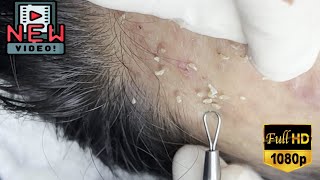 Satisfying SkinCare Blackheads Acne Extraction Video With Dr Thuy QGSPA Date11112024 [upl. by Shore]