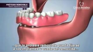 Prótesis dental en Madrid  Clínica Dental Bernabeu [upl. by Vrablik]