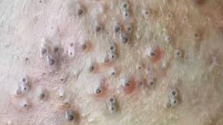 Blackheads amp Whiteheads Satisfying Removal 0072 [upl. by Adniles841]