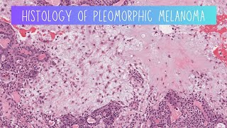 Histology of Pleomorphic adenoma [upl. by Krusche]