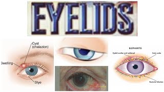 Eyelids 5 Minor Topic Phthiriasis PalpebrumTrichiasis [upl. by Kling]