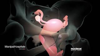 How Is A Robotic Hysterectomy Done  Robotic Hysterectomy Surgery  Gynaecology  Manipal Hospitals [upl. by Grimbly670]