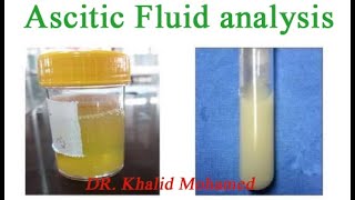 Ascitic fluid analysis تحليل السائل البريتوني [upl. by Nitaj363]