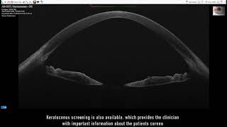 Anterior Segment OCT  MS39 [upl. by Notlaw]