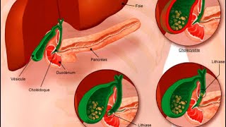 GASTROENTEROLOGIE  angiocholite pancréatite aigue cholécystite aigue colique hépatique [upl. by Clyve]