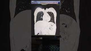 CT SCAN OF CHEST PLAINviral medical shortfeeds 1000subscriber radiology million [upl. by Nawrocki]