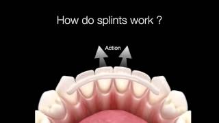 How Do Dental Splints Work [upl. by Starlin967]