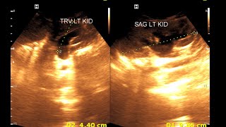 Bilateral hydro nephrosis  Bilateral dilated ureter  Renal Ultrasonography [upl. by Neoma713]