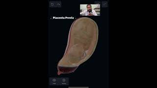 Placenta Previa  Placenta  Pregnancy Compilation  Pregnancy placenta pregnancy complication [upl. by Fita486]