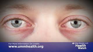 Health Watch Uveitis Causes and Treatment [upl. by Suirauqed976]