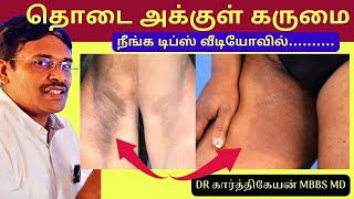 தொடை அக்குள் கருமை நீங்க டிப்ஸ்  black patches dark skin removal  Home Remedies [upl. by Elgna]